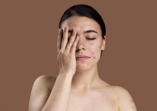 5 Foods that cause acne that must be avoided
